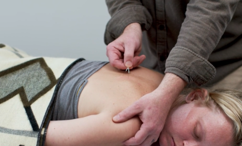 Advanced Myofascial Acupuncture Techniques